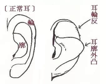 耳骨突出 面相|面相耳朵案例详解：九种不同的耳朵，九种不同的出生